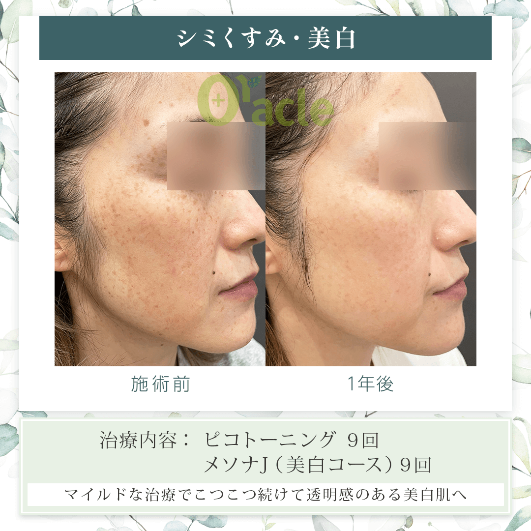 シミくすみ・美白の施術前・施術1年後の画像です。※【治療内容】ピコトーニング 9回、メソナJ(美白コース)9回
