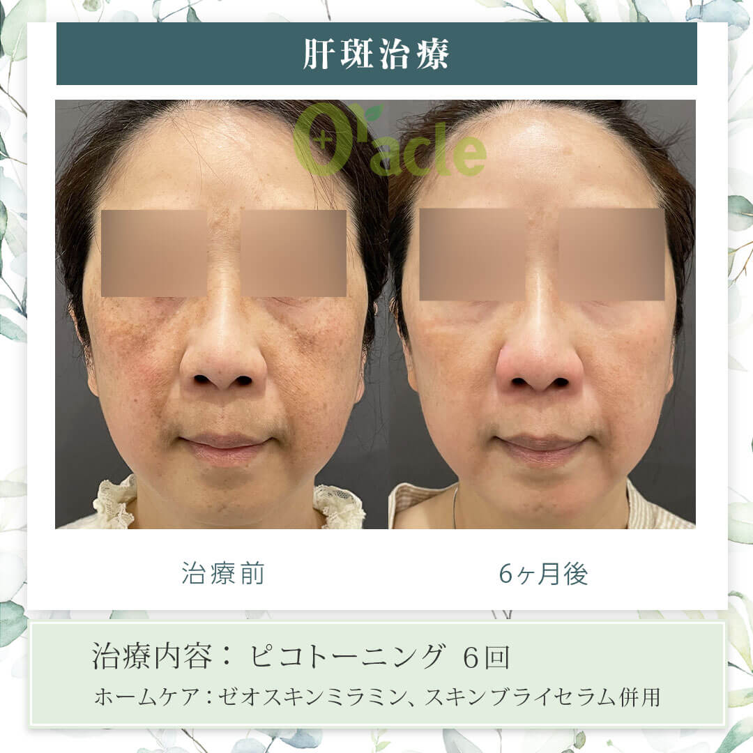 肝斑治療の治療前・治療6ヶ月後の画像です。※【治療内容】ピコトーニング 6回【ホームケア】ゼオスキンミラミン、スキンブライセラム併用