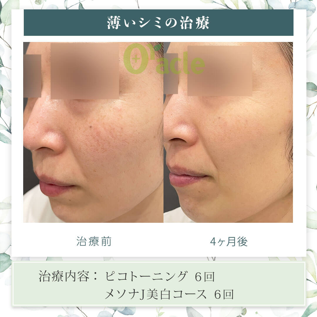 薄いシミの治療の治療前・治療4ヶ月後の画像です。※【治療内容】ピコトーニング 6回、メソナJ美白コース 6回